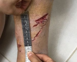 Tubarão ataca turista francês em Praia de Ubatuba