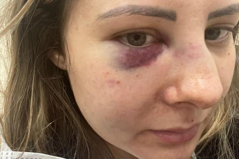 Mulher é agredida pelo companheiro em Taubaté e quebra mandíbula e nariz