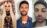 Miss Drag Queem São José dos Campos é brutalmente espancada e polícia investiga o caso